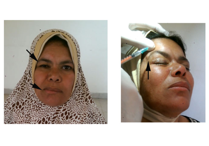 Services for medical Botox