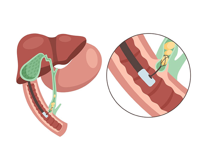 Treatment for stroke thrombolysis
